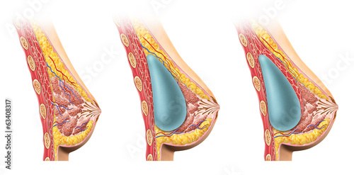 Woman breast implant cross section.