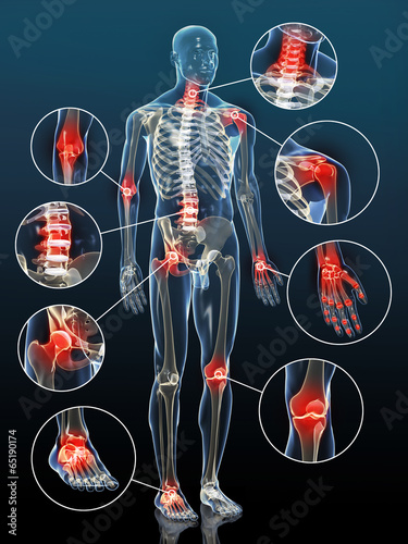 Gelenkentzündungen bei Arthrose