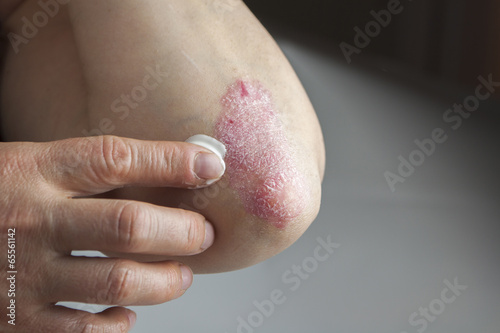 Psoriasis on elbow. Medical treatment