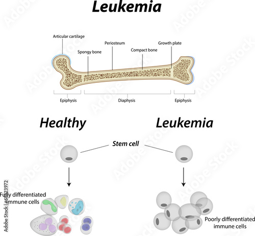 Leukemia Bone