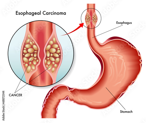 carcinoma esofageo