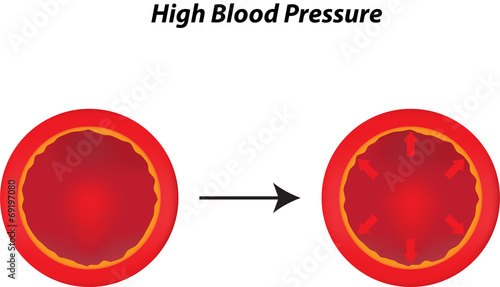 High Blood Pressure