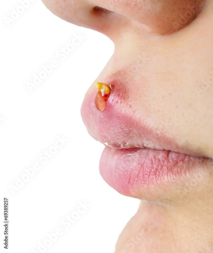 Closeup of woman with huge acne outbreak on upper lip