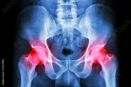 human's pelvis and arthritis at both hip joint (Gout,Rheumatoid)