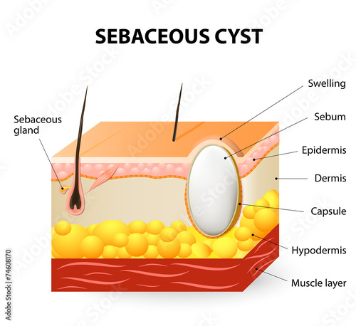 Sebaceous cyst or trichilemmal cyst