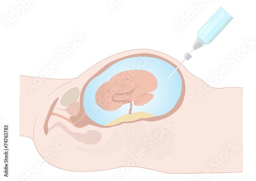 amniocentesi