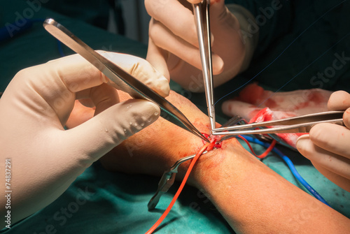 arteriovenous fistula operation for dialysis