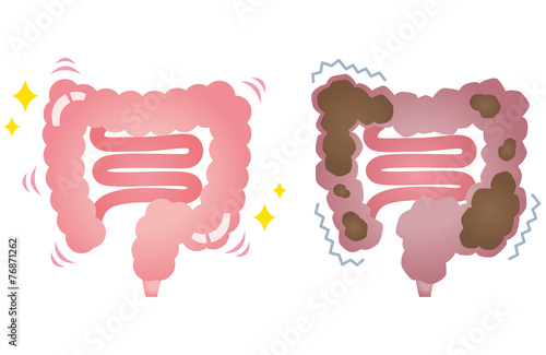 健康な大腸 便秘の大腸