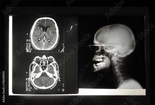 Radiographie du crâne