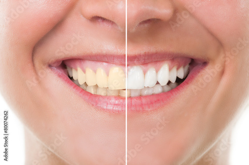 Before and after whitening