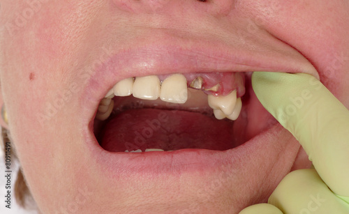 Dental, closeup of broken artificial tooth and dentist hand