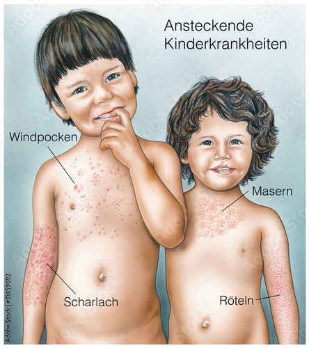 Ansteckende Kinderkrankheiten.Windpocken.Masern.Scharlach.Röteln