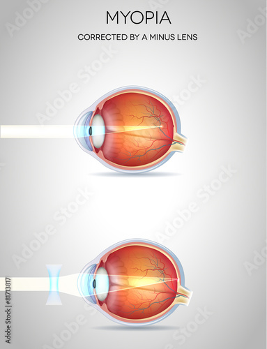 Myopia and myopia corrected by a minus lens. Eye vision disorder