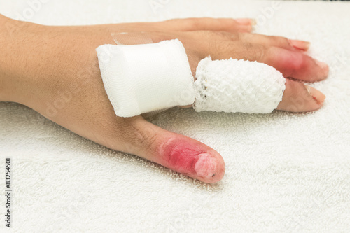  injured finger wrapped in a gauze bandage
