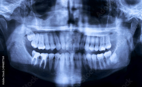 Panoramic dental X-Ray
