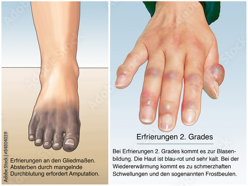 Erfrierungen. Amputationsverletzung. Erste Hilfe