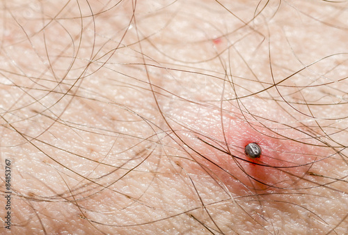 Tick attached on man skin
