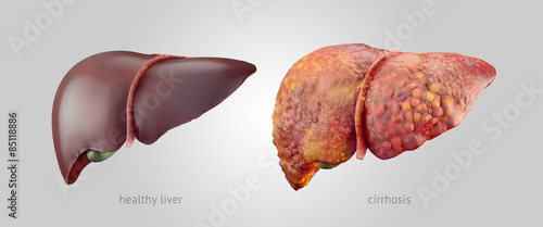 Realistic illustration of healthy and sick human livers