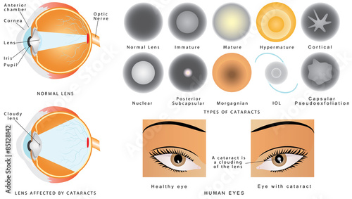 Eye disease cataract