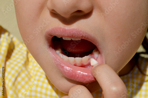 Little girl showing her loose baby tooth