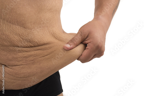 man with fat belly and stretch marks