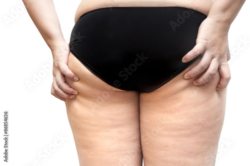 Buttock and leg cellulite problem young woman stretch marks