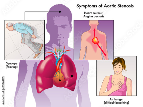 sintomi stenosi aortica