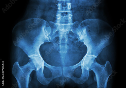 Film X-ray of Pelvis