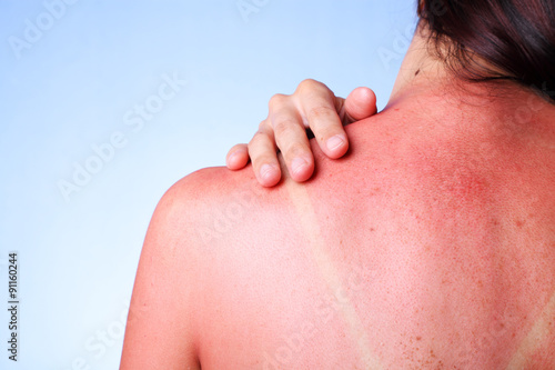 A female touching her sunburned shoulder