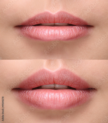 Sexy plump lips after filler injection