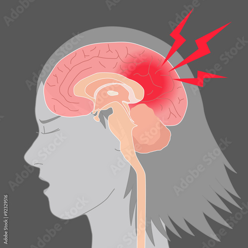 headache, cerebral hemorrhage, brain stroke, image illustration