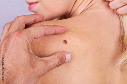 Doctor, dermatologist, hands examines a birthmark of patient. Checking benign moles