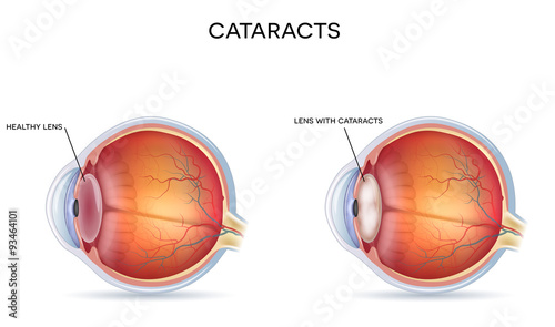 Cataracts