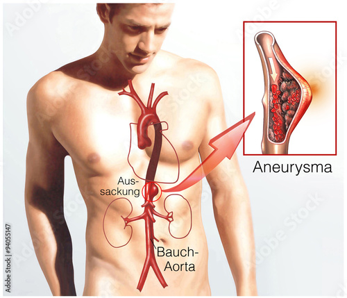 Aneurysma.Bauchaorta.Aussackung