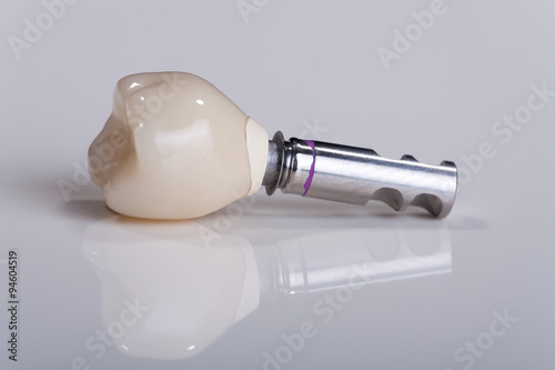 Zahn Implantat Nahaufnahme
