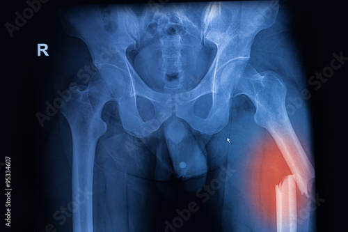 X-ray image of both hip showing femur fracture at left side