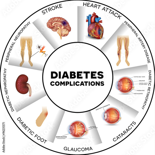 Diabetes complications