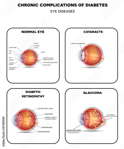 Diabetic Eye Diseases. Diabetic retinopathy, cataract and glaucoma. Also healthy eye detailed anatomy.