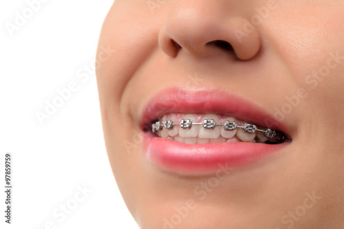 Healthy smile - teeth with dental braces