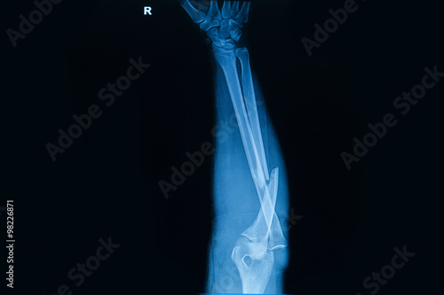 Collection of human x-rays showing fracture of radius bone