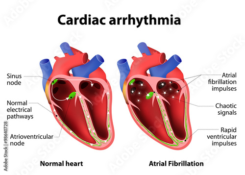 Cardiac arrhythmia