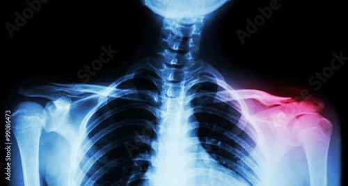 Film x-ray both clavicle AP ( front view ) : show fracture distal left clavicle