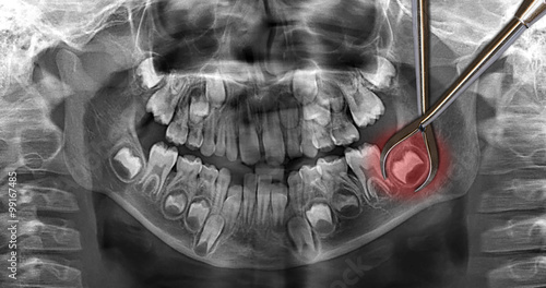 dental scan: wisdom teeth