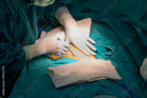 cesarean