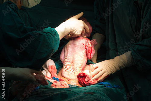 cesarean