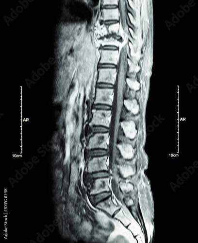 Spine metastasis ( cancer spread to thoracic spine ) ( MRI of thoracic and lumbar spine : show thoracic spine metastasis and compress spinal cord ( Myelopathy ) ) ( sagittal plane )