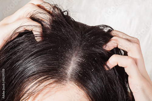 Dander that causes itching scalp