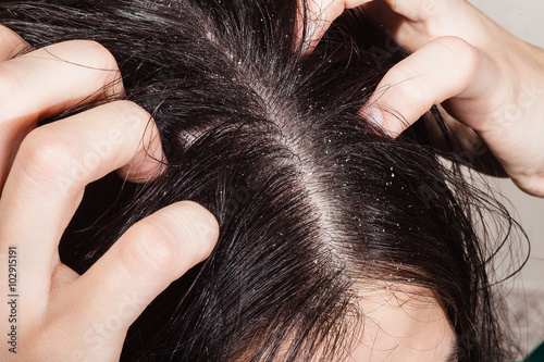 Dander that causes itching scalp