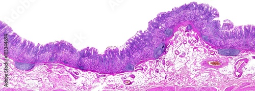 Chronic gastritis of a human