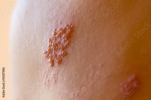 Shingles on men herpes zoster. Closeup.